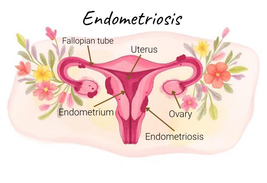 Cross section of women's reproductive organs effected by Endometriosis.  Includes: Fallopian tube, Uterus, Ovary and spots effected by Endometriosis