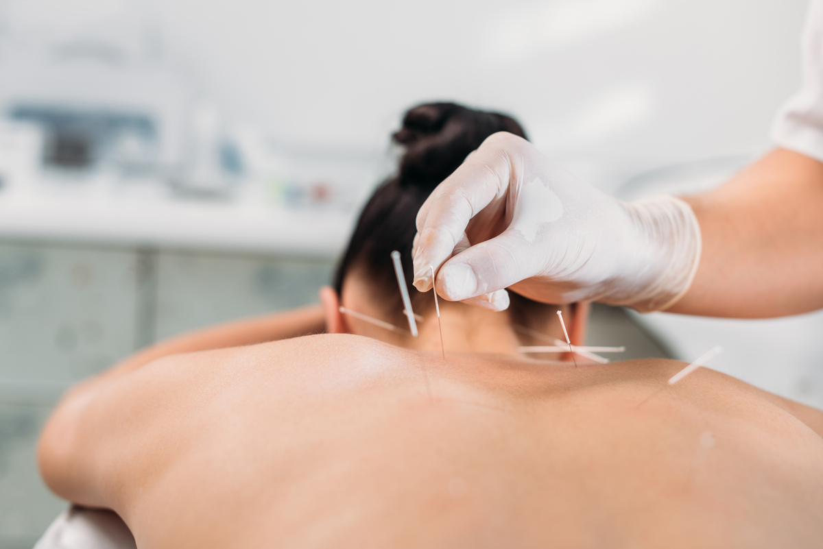 cropped shot of cosmetologist putting needles on woman's back