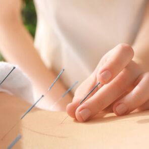 acupuncture 